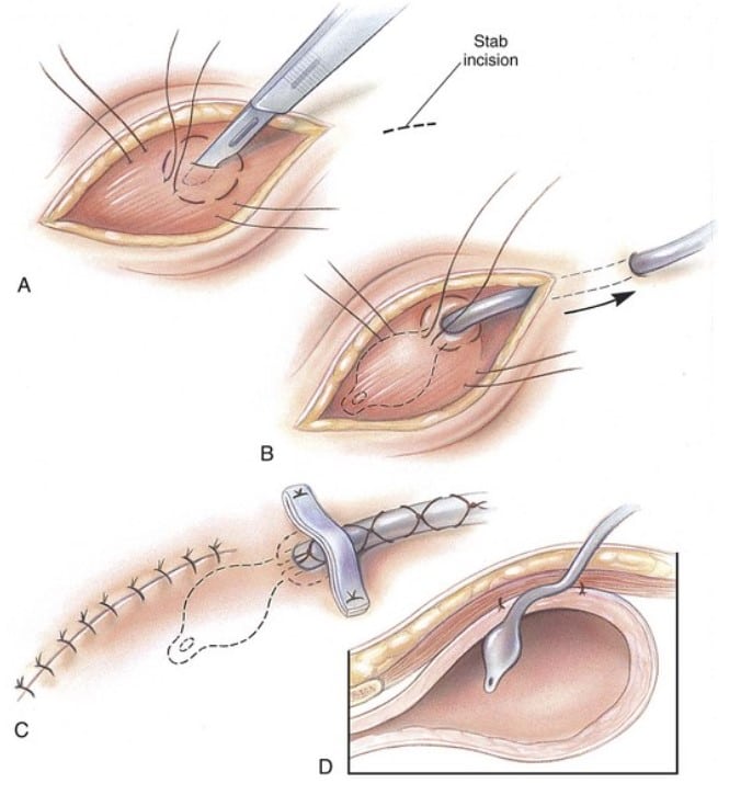 Urinary Bladder Surgery for Stones (Cystotomy) in Pets What Happens in Surgery (Cystotomy)?