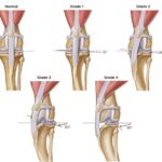 Canine Patellar Luxation: Causes, Grades, Symptoms, Treatment, and Prognosis Canine Patellar Luxation: Causes, Grades, Symptoms, Treatment, and Prognosis